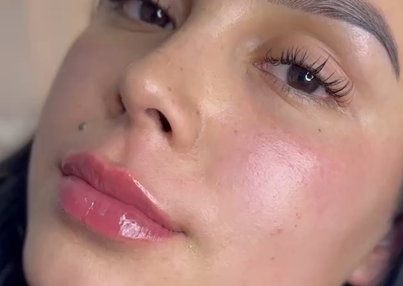 Tratamiento con ácido hialurónico en labios y rostro